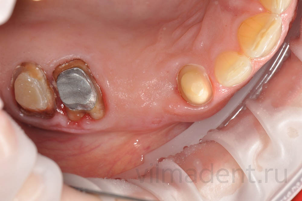 Восстановление жевательных зубов коронками из диоксида циркония
