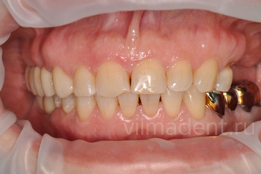 Восстановление жевательных зубов коронками из диоксида циркония