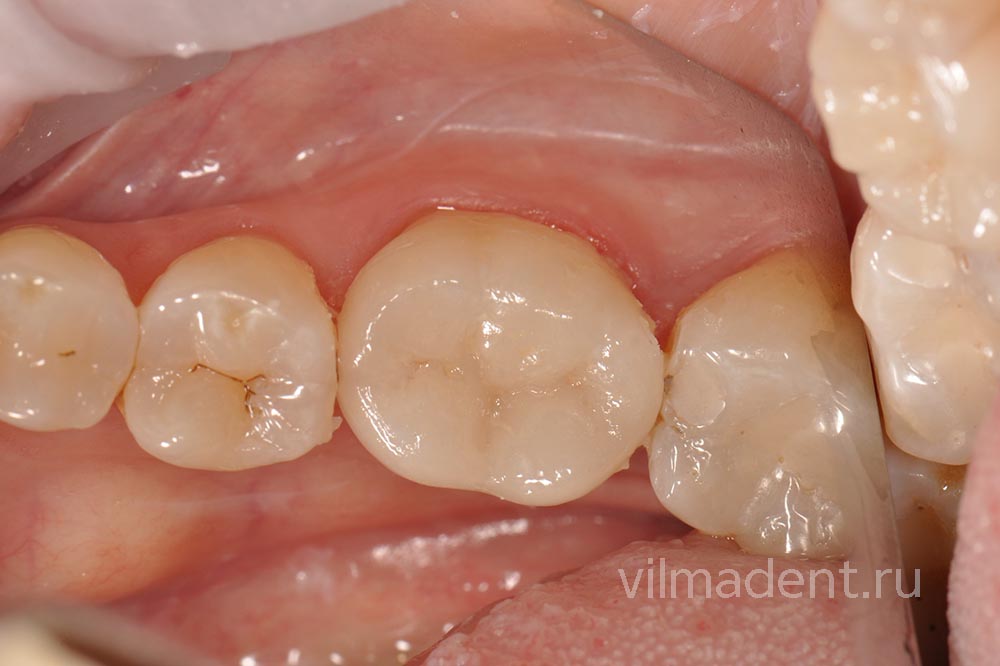 Восстановление зуба накладкой EMAX