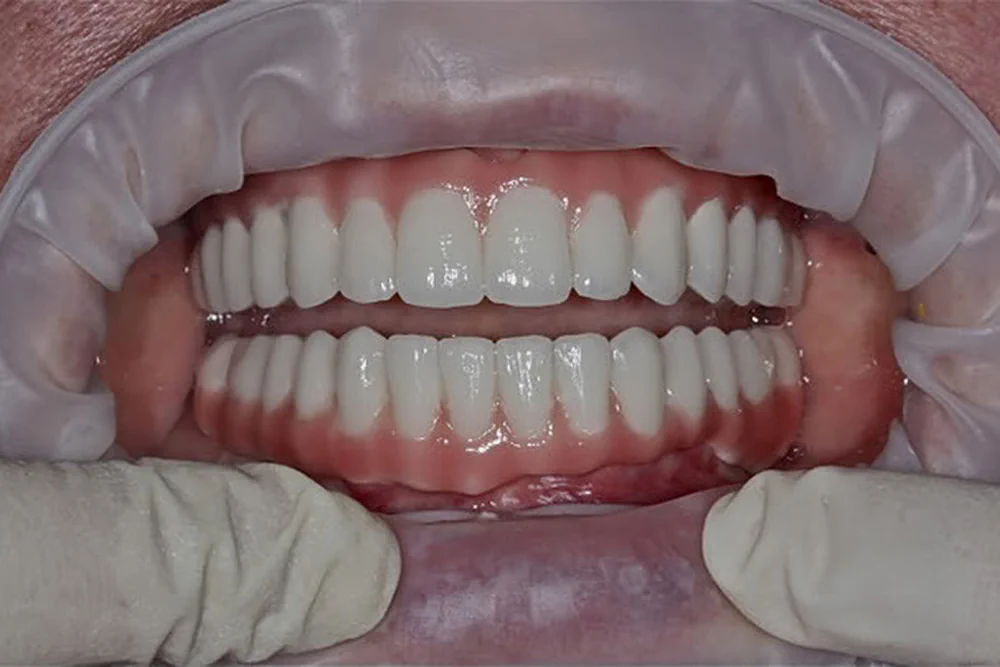 Беззубые челюсти. Цельноциркониевая балка.