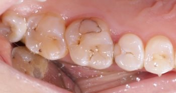 Как выбрать подходящий метод лечения кариеса?