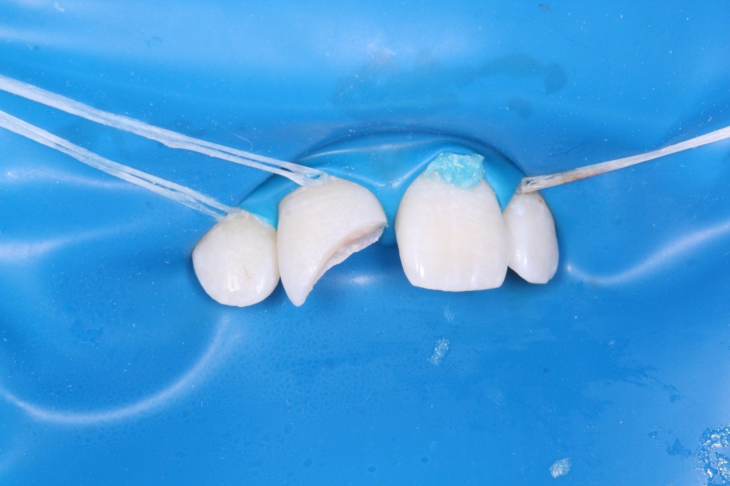 Механические травмы зуба