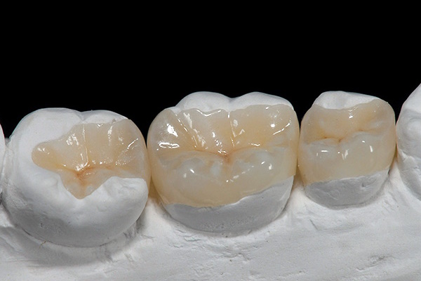 Как выбрать зубные вкладки для восстановления зубов?
