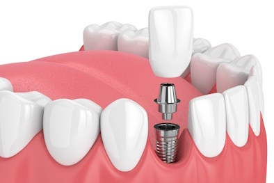 В каких случаях показано протезирование зубов